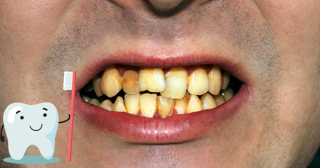 黄ばむ歯